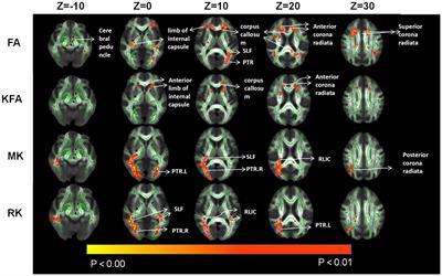 Diffusion kurtosis imaging of brain white matter alteration in patients with coronary artery disease based on the TBSS method